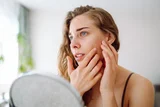 Ayurvedic Treatment for Rosacea – Soothing Herbal Care