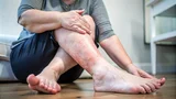 Water Retention Cure Ayurveda – Effective Natural Remedies