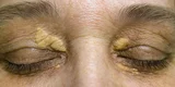 Effective Xanthelasma Treatment in Ayurveda for Clearer Skin