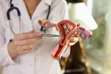 Shigru Guggulu for Fibroids: Holistic Support for Women’s Health