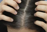 Palitya – Ayurvedic Perspective on Premature Graying of Hair