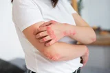 Mathan Thailam: Ayurvedic Remedy for Skin Disorders