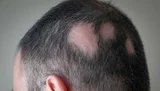 Alopecia Areata Ayurvedic Treatment – Natural Remedies for Hair Regrowth & Scalp Health