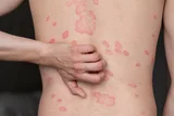 Psoria Oil Uses – Ayurvedic Remedy for Psoriasis & Skin Health
