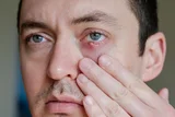 Ayurvedic Treatment for Abscess – Natural Remedies to Promote Healing