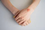 Ganglion Cyst Treatment in Ayurveda – Natural Remedies & Holistic Healing