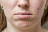 Ayurvedic Medicine for Herpes – Natural Remedies & Treatments