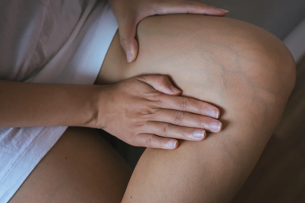 Ayurvedic Treatment & Remedies for Varicose Veins