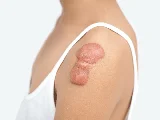 Keloid Treatment in Ayurveda – Natural Healing Approaches