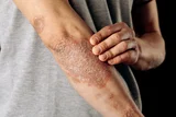 Kushta Chikitsa – Revitalizing Skin Health with Ayurveda