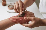 Dushta Vrana – Ayurvedic Management of Chronic & Infected Wounds