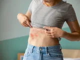 Visarpa Chikitsa – Traditional Ayurvedic Approach for Spreading Skin Conditions