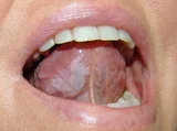 Leukoplakia Treatment in Ayurveda – Natural Remedies & Holistic Approach
