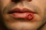 Syphilis Treatment in Ayurveda: Herbal Remedies and Healing Practices