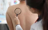Ayurveda's Approach to Skin Tags