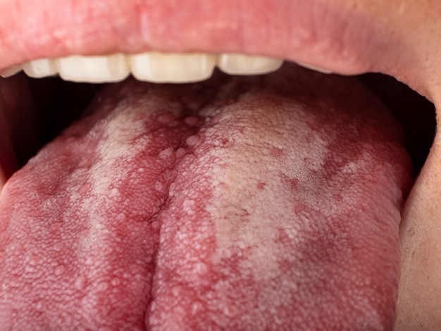 Tongue with stomatitis close up oral cancer