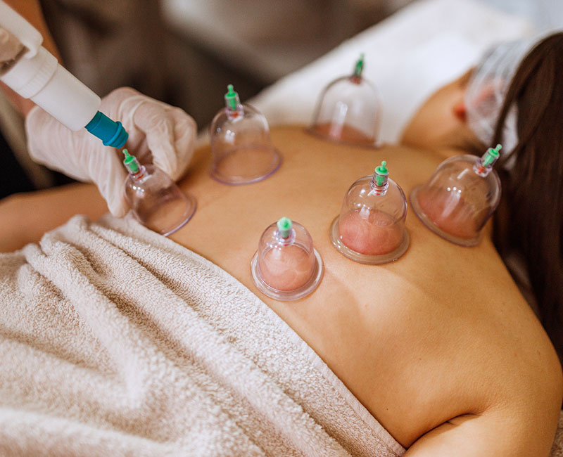 Cupping Therapy: Definition, Types & Benefits