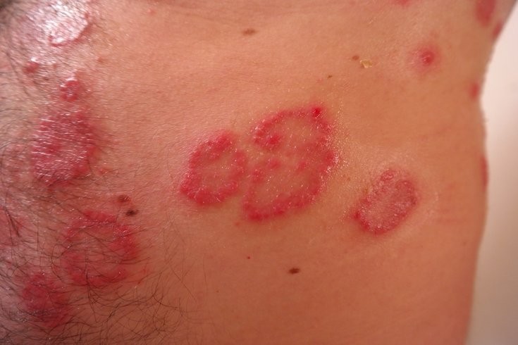 How to treat Psoriasis through Ayurveda?
