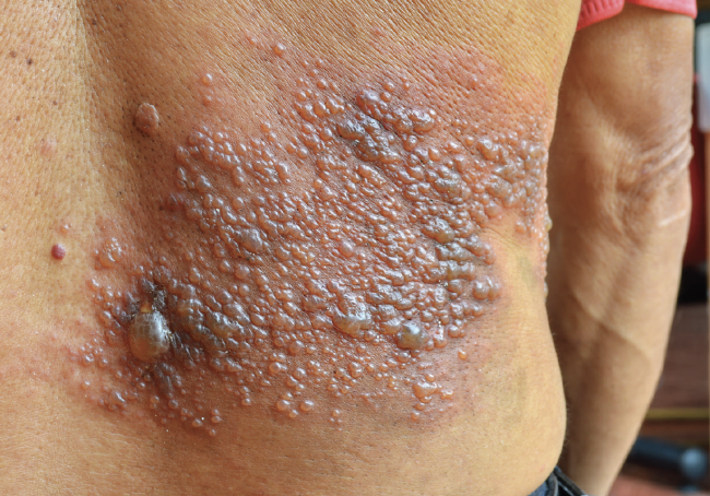 Treating Zoster-Associated Pain and Postherpetic Neuralgia