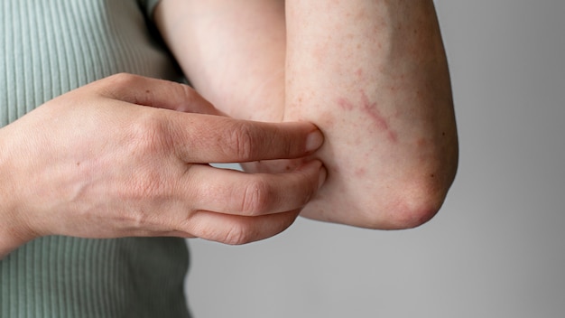 Skin allergy reaction test on arm