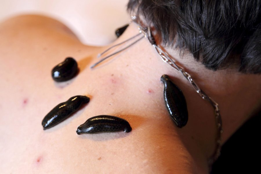 Raktamokshana Ayurvedic Treatment: Types, Benefits & Procedure