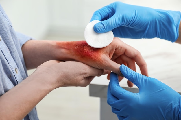 Doctor covering patient's burn of hand with cotton pad indoors closeup