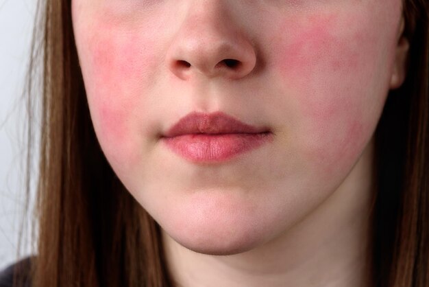 Close up view on the cheek of a woman with red cheeks after the wind Allergy concept